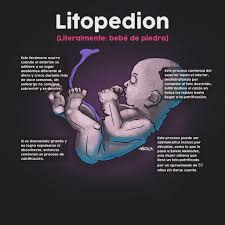 Descubra o Que é Litopedion